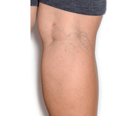 sclerotherapy Tactus Health