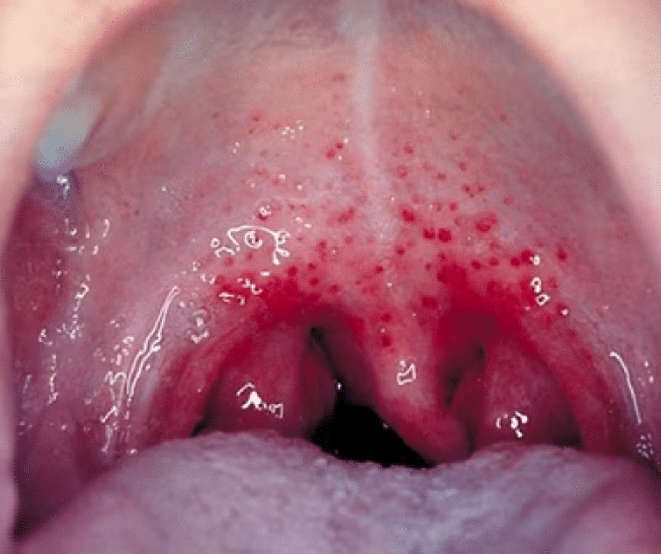 What is Strep Throat?