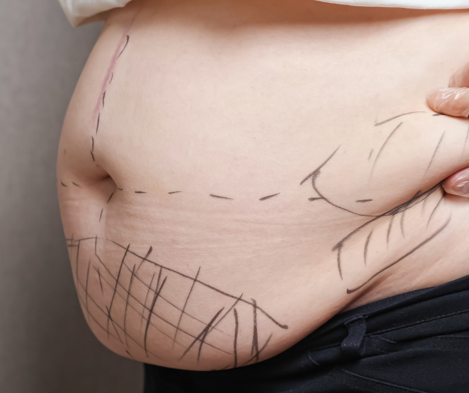 What is Liposuction?