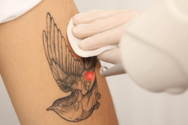 Tattoo Removal by Tactus Health